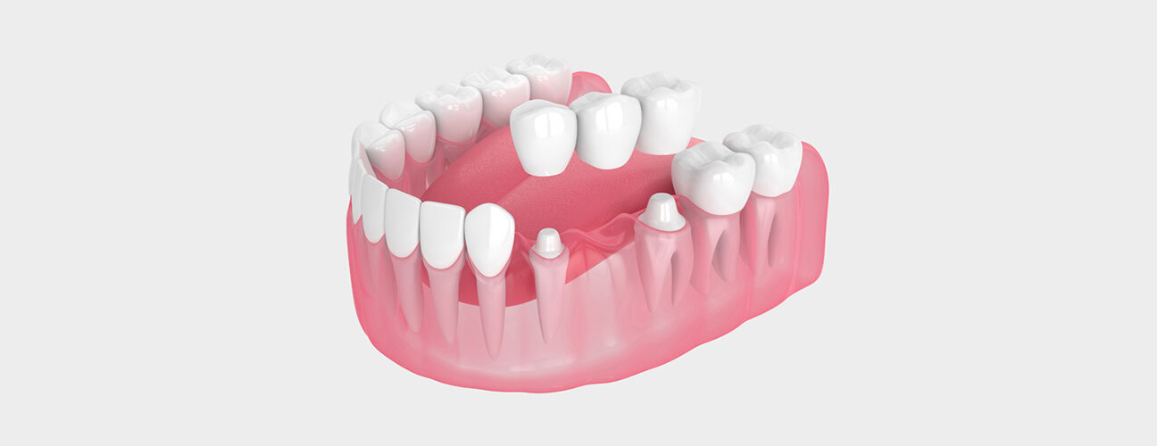 Dental Bridges