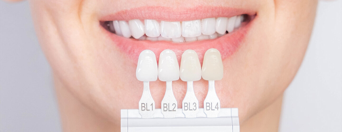 Dental-Veneers
