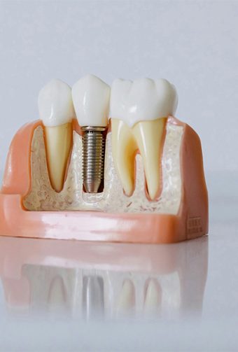 How to Fix a Loose Implant Tooth: Causes and Solutions